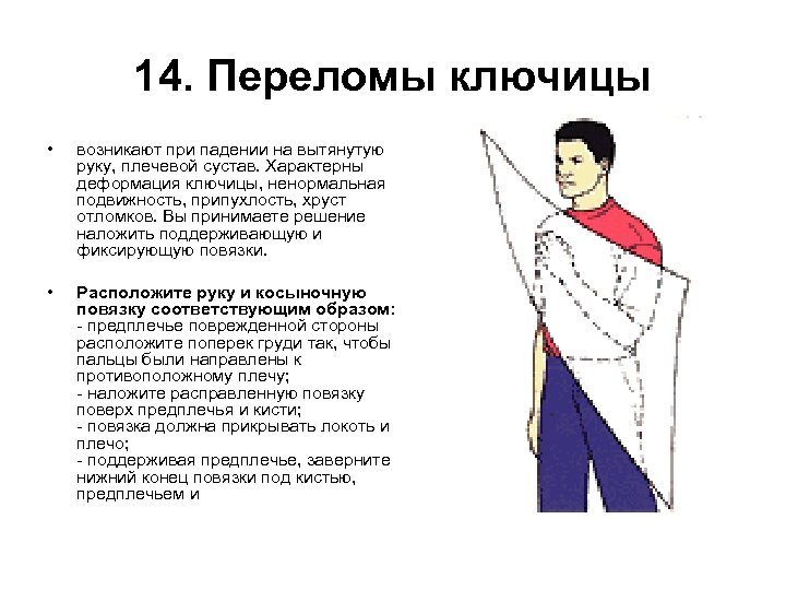 14. Переломы ключицы • возникают при падении на вытянутую руку, плечевой сустав. Характерны деформация