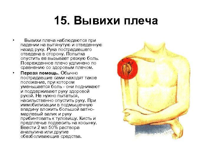 15. Вывихи плеча • • Вывихи плеча наблюдаются при падении на вытянутую и отведенную