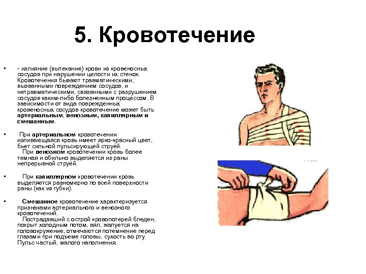 5. Кровотечение • • - излияние (вытекание) крови из кровеносных сосудов при нарушении целости