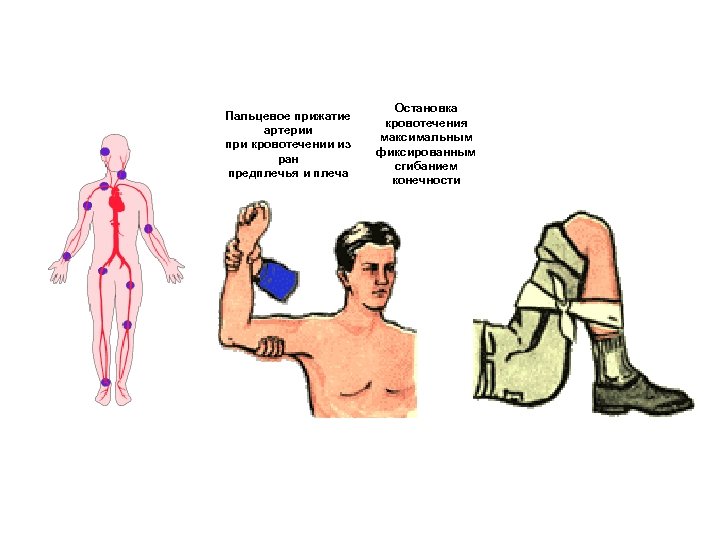 Пальцевое прижатие артерии при кровотечении из ран предплечья и плеча Остановка кровотечения максимальным фиксированным