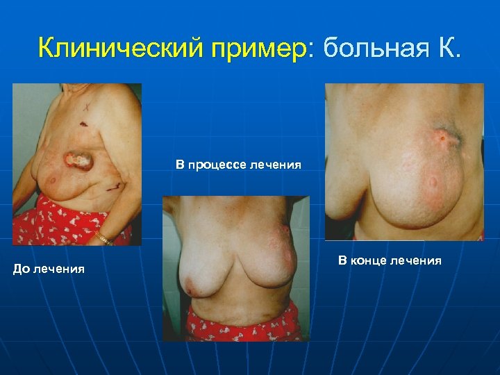 Клинический пример: больная К. В процессе лечения До лечения В конце лечения 