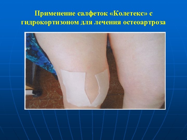 Применение салфеток «Колетекс» с гидрокортизоном для лечения остеоартроза 