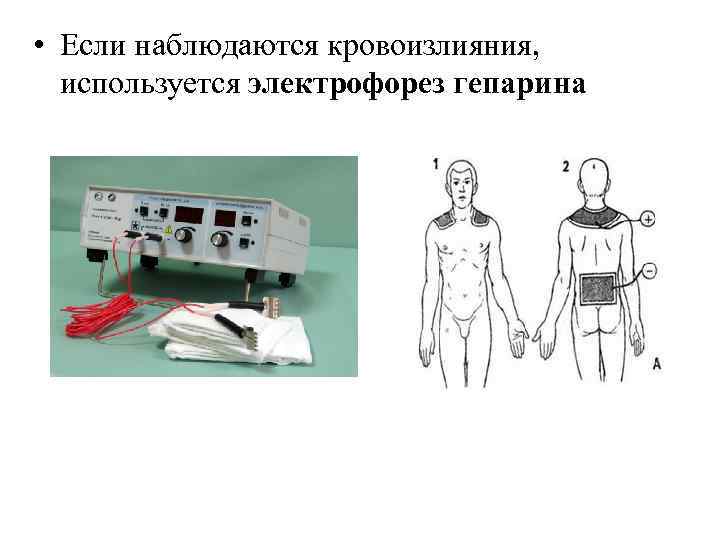  • Если наблюдаются кровоизлияния, используется электрофорез гепарина 