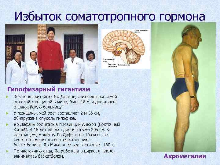 Избыток соматотропного гормона Гипофизарный гигантизм ► ► 36 -летняя китаянка Яо Дэфэнь, считающаяся самой