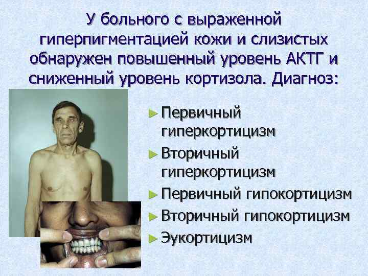 У больного с выраженной гиперпигментацией кожи и слизистых обнаружен повышенный уровень АКТГ и сниженный