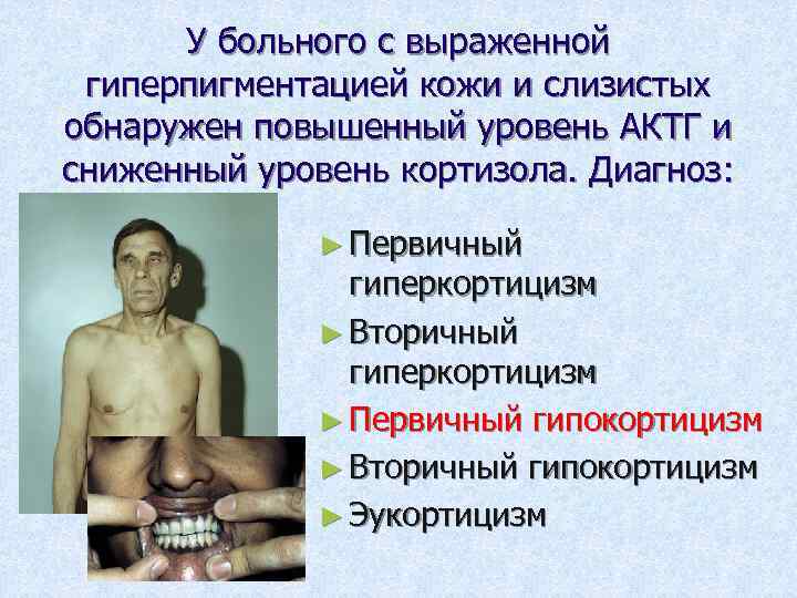 У больного с выраженной гиперпигментацией кожи и слизистых обнаружен повышенный уровень АКТГ и сниженный