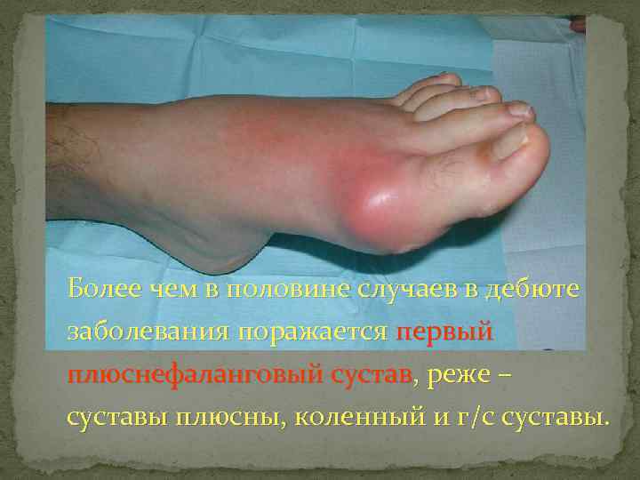Более чем в половине случаев в дебюте заболевания поражается первый плюснефаланговый сустав, реже –