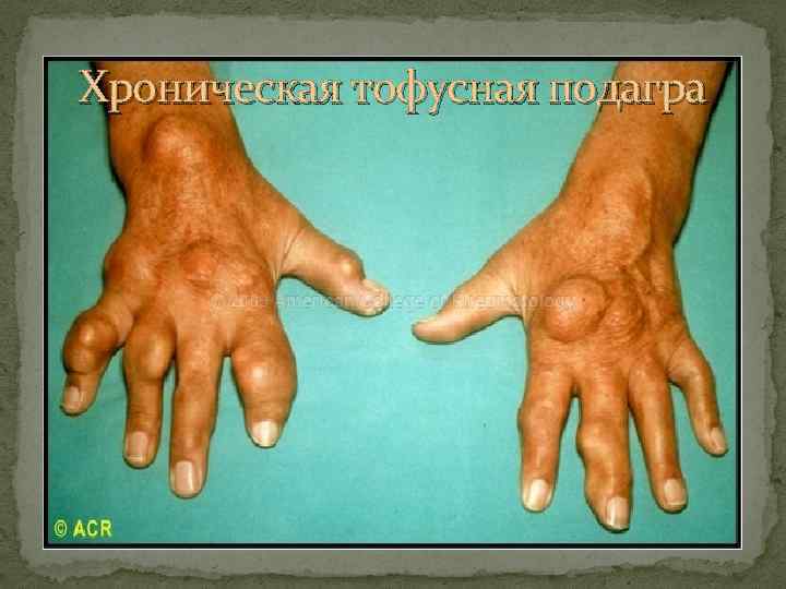 Хроническая тофусная подагра 
