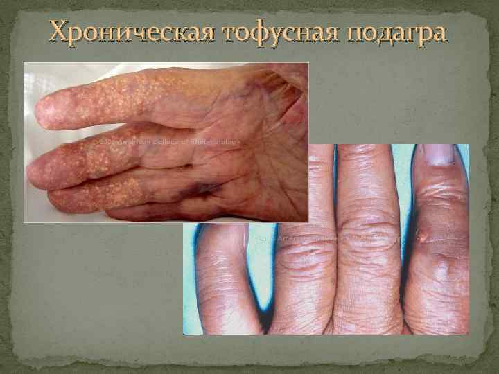 Хроническая тофусная подагра 
