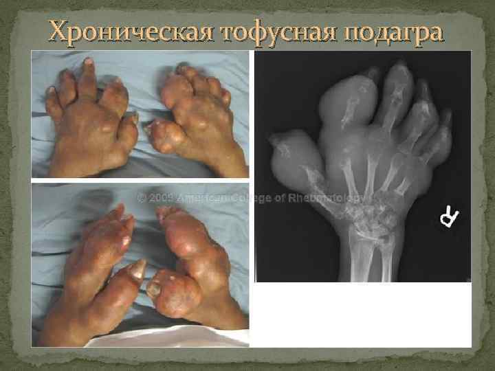 Хроническая тофусная подагра 