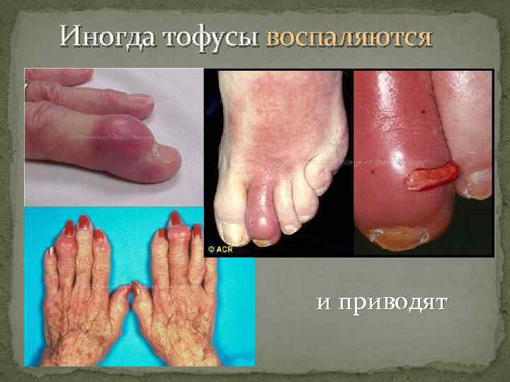 Иногда тофусы воспаляются и приводят 