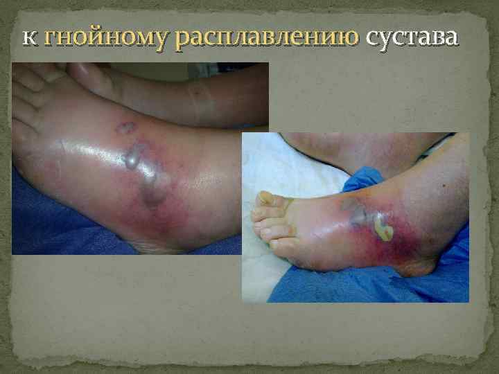 к гнойному расплавлению сустава 