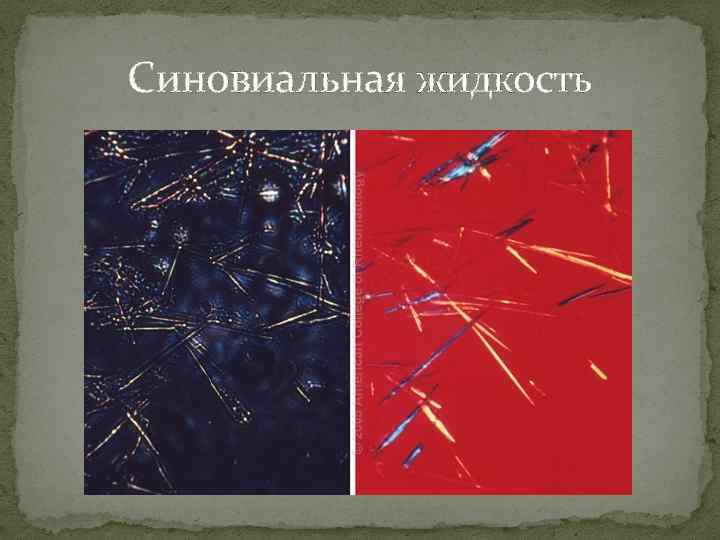 Синовиальная жидкость 