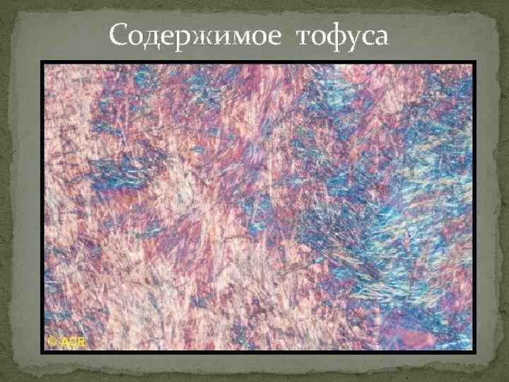 Содержимое тофуса 