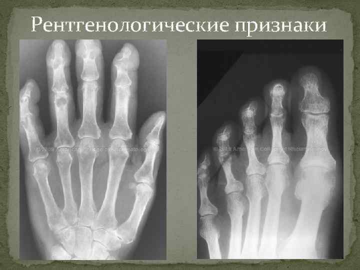 Рентгенологические признаки 