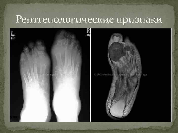 Рентгенологические признаки 