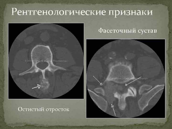 Рентгенологические признаки Фасеточный сустав Остистый отросток 