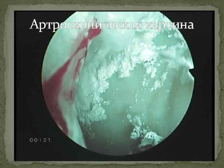 Артроскопическая картина 