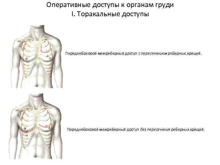 Оперативные доступы к органам груди I. Торакальные доступы Переднебоковой межреберный доступ с пересечением реберных