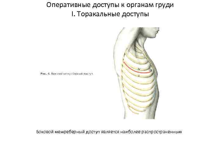 Оперативные доступы к органам груди I. Торакальные доступы Боковой межреберный доступ является наиболее распространенным
