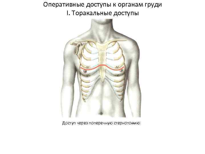 Оперативные доступы к органам груди I. Торакальные доступы Доступ через поперечную стернотомию 