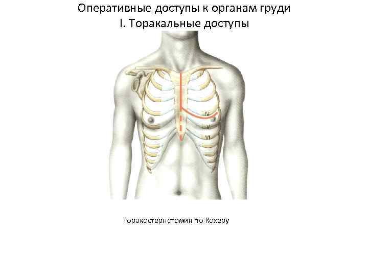 Оперативные доступы к органам груди I. Торакальные доступы Торакостернотомия по Кохеру 