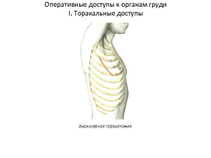Оперативные доступы к органам груди I. Торакальные доступы Аксиллярная торакотомия 