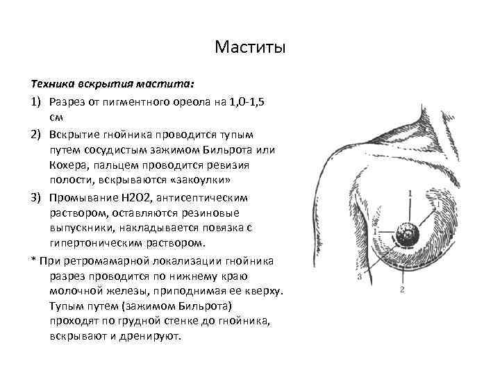 Маститы Техника вскрытия мастита: 1) Разрез от пигментного ореола на 1, 0 -1, 5