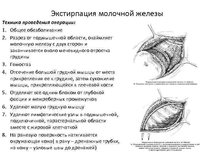 Экстирпация молочной железы Техника проведения операции: 1. Общее обезболивание 2. Разрез от подмышечной области,