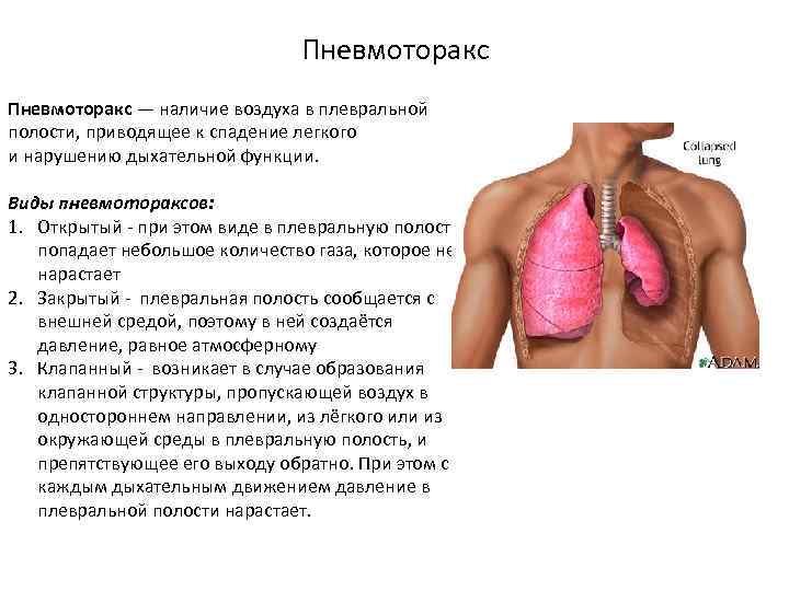 Пневмоторакс — наличие воздуха в плевральной полости, приводящее к спадение легкого и нарушению дыхательной