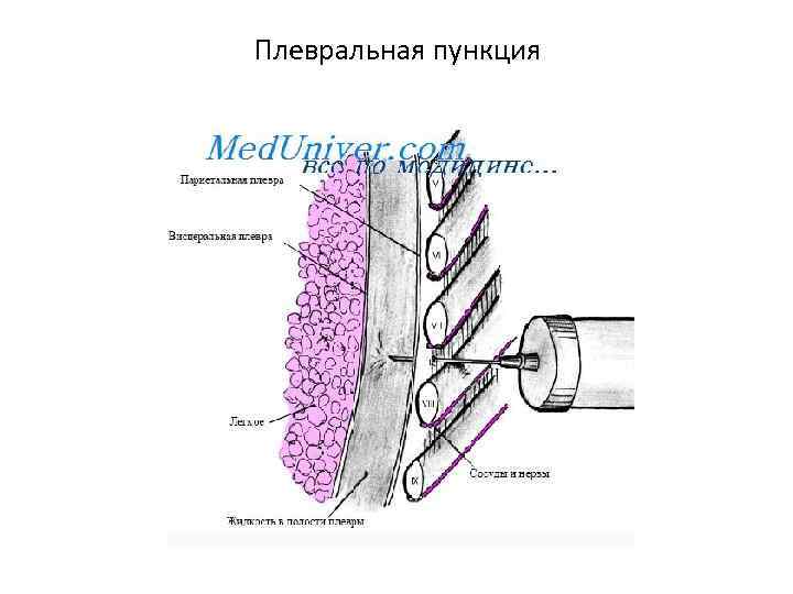 Плевральная пункция 