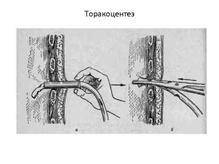 Торакоцентез 