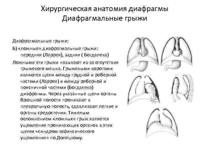 Хирургическая анатомия диафрагмы Диафрагмальные грыжи: Б) «ложные» диафрагмальные грыжи: передняя (Ларрея), задняя ( Богдалека)