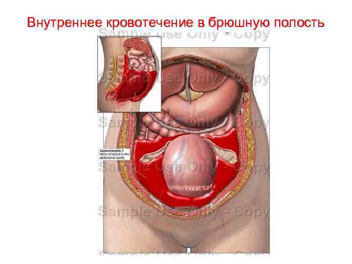 Внутреннее кровотечение в брюшную полость 