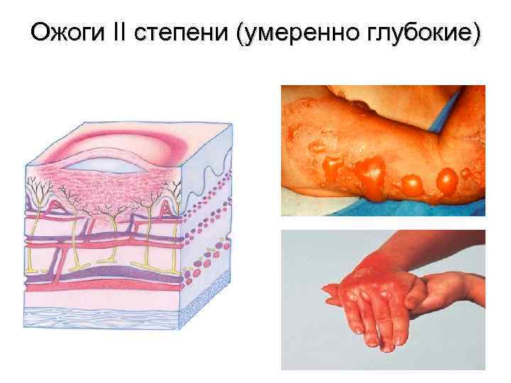 Ожоги II степени (умеренно глубокие) 