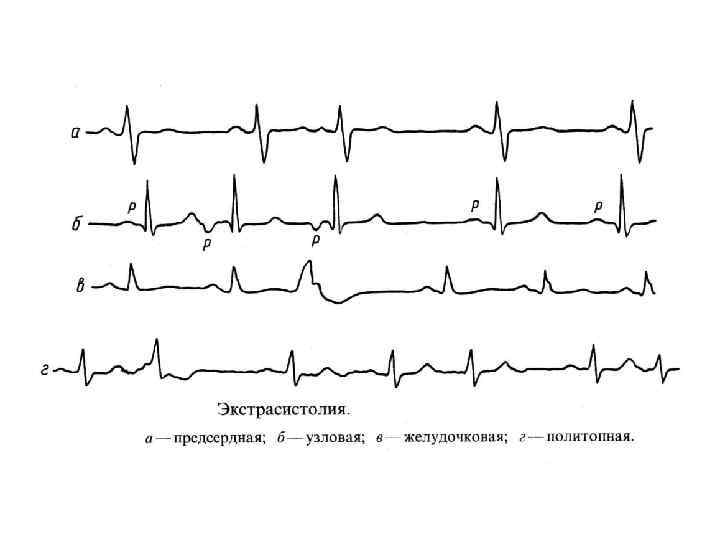 Желудочковая экстрасистолия картинки