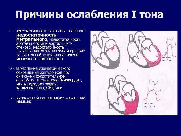 Причины ослабления I тона а - негерметичность закрытия клапанов: недостаточность митрального, недостаточность аортального или