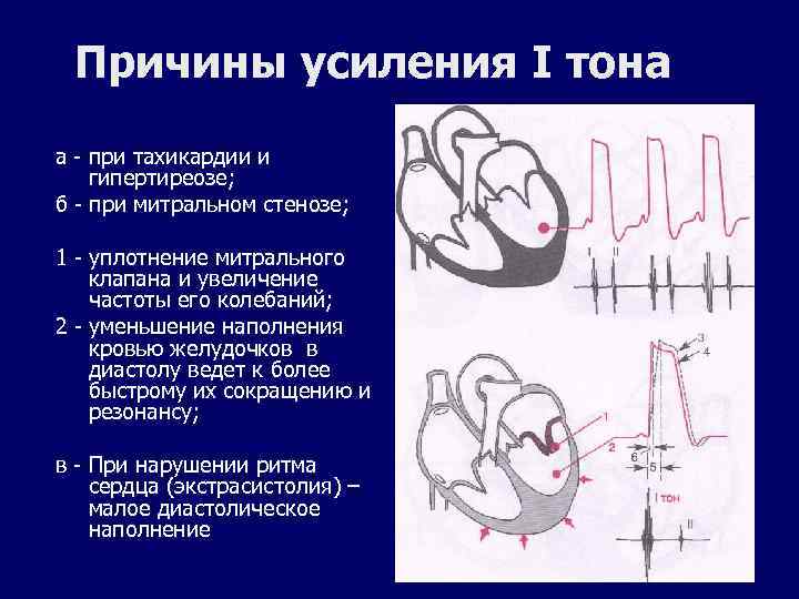 Причины усиления I тона а - при тахикардии и гипертиреозе; б - при митральном