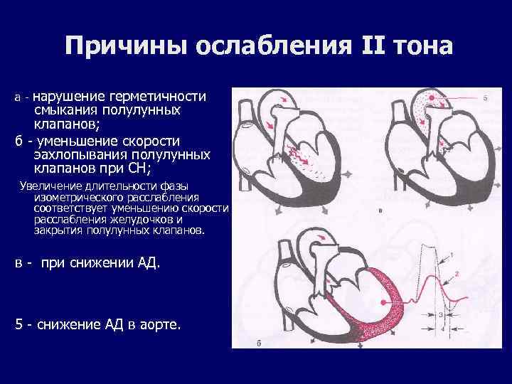 Причины ослабления II тона а - нарушение герметичности смыкания полулунных клапанов; б - уменьшение