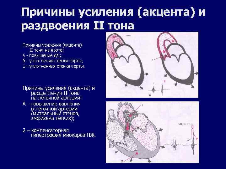 Причины усиления (акцента) и раздвоения II тона Причины усиления (акцента) II тона на аорте: