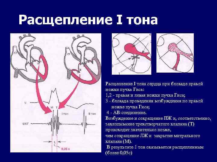 Расщепление I тона сердца при блокаде правой ножки пучка Гиса: 1, 2 - правая