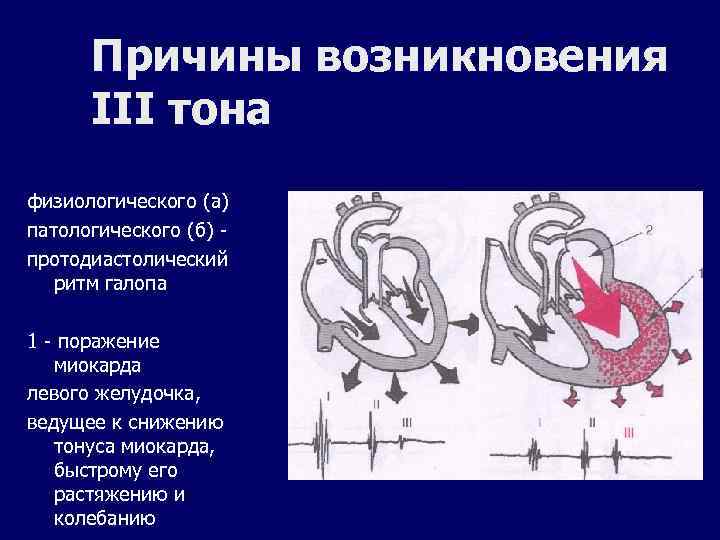 Ритм галопа при каком заболевании