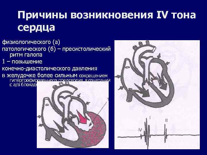 Причины возникновения IV тона сердца физиологического (а) патологического (б) – пресистолический ритм галопа 1