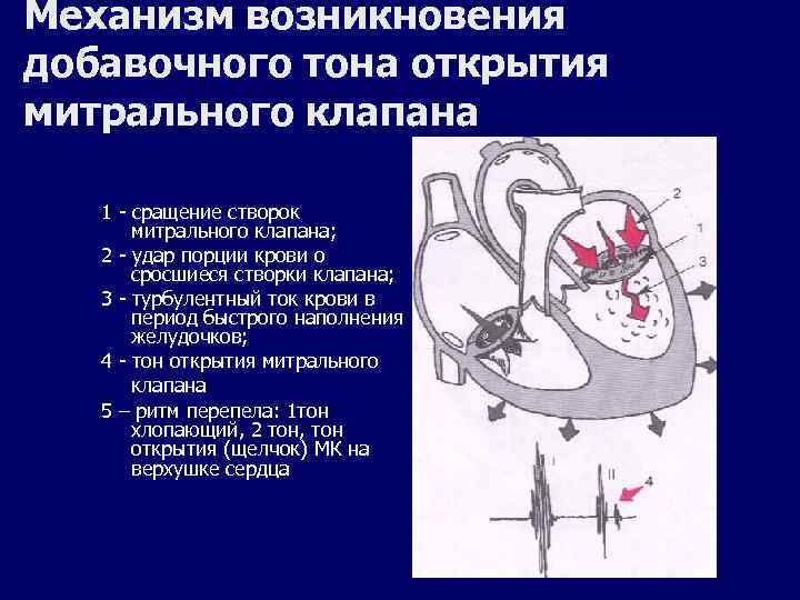 Механизм возникновения добавочного тона открытия митрального клапана 1 - сращение створок митрального клапана; 2