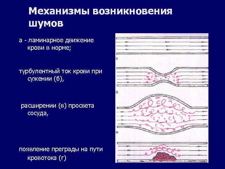 Механизмы возникновения шумов а - ламинарное движение крови в норме; турбулентный ток крови при