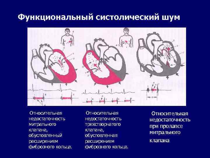 Функциональный систолический шум Относительная недостаточность митрального клапана, обусловленный расширением фиброзного кольца. Относительная недостаточность трехстворчатого