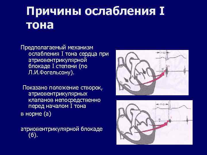 Причины ослабления I тона Предполагаемый механизм ослабления I тона сердца при атриовентрикулярной блокаде I