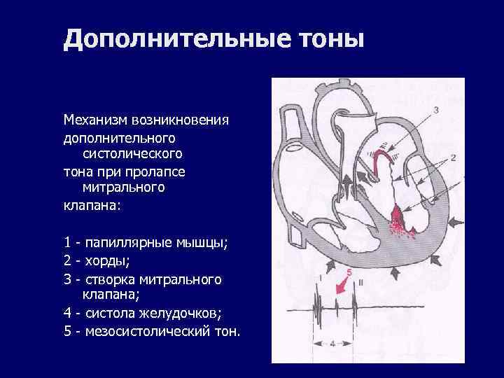 Дополнительные тоны Механизм возникновения дополнительного систолического тона при пролапсе митрального клапана: 1 - папиллярные