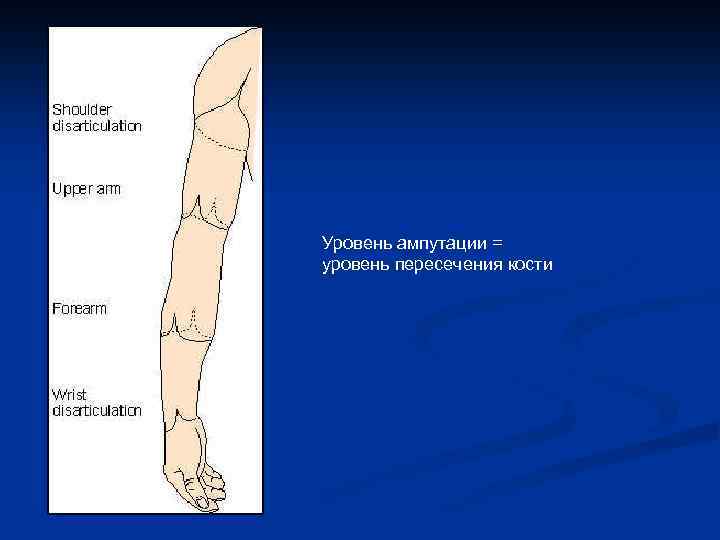 Уровень ампутации = уровень пересечения кости 