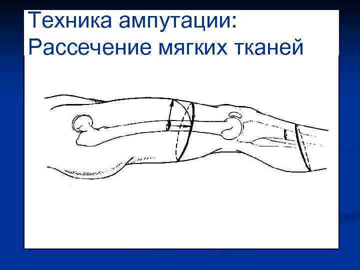 Техника ампутации: Рассечение мягких тканей 